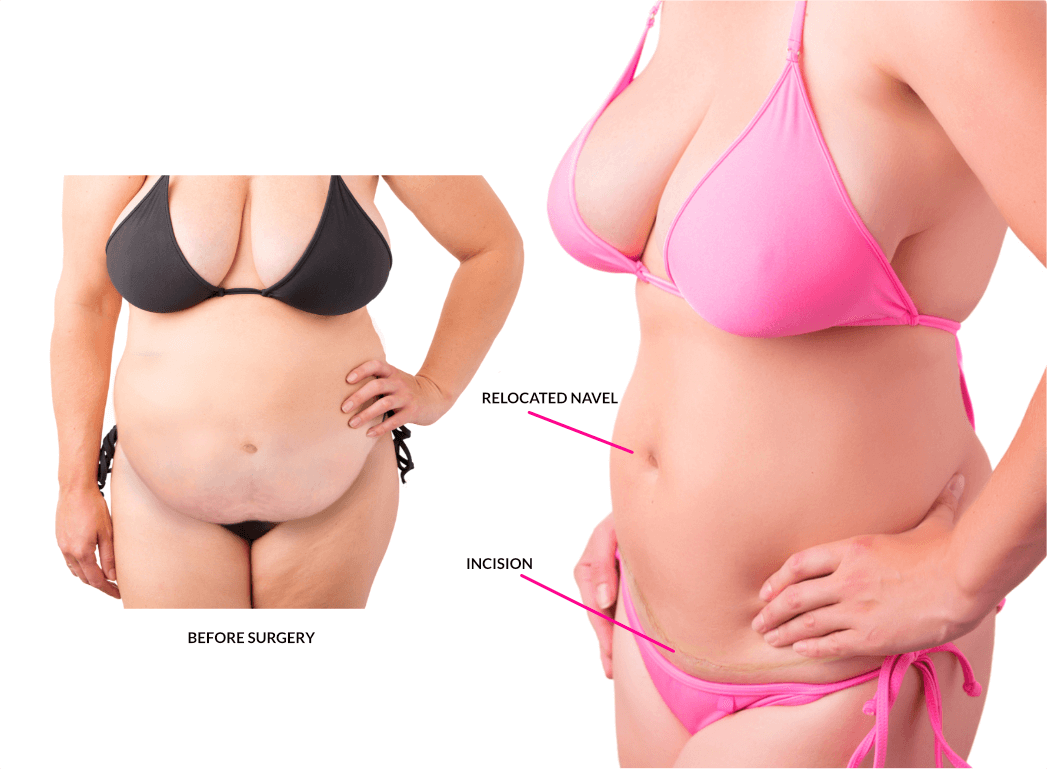 Abdominoplasty