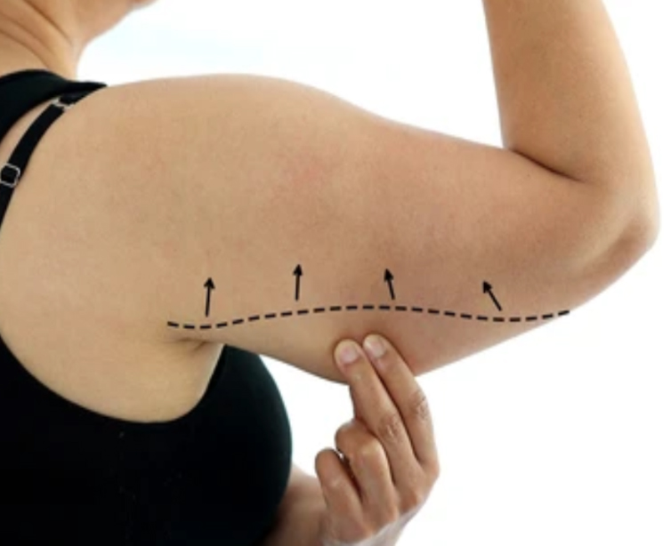 Arm Lift1