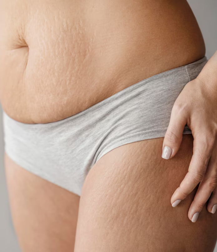 Body skin collection (T method)