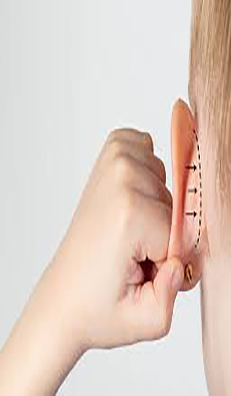 Repair of big ears 3