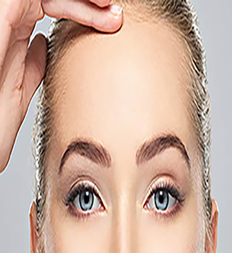 forehead-lift-img
