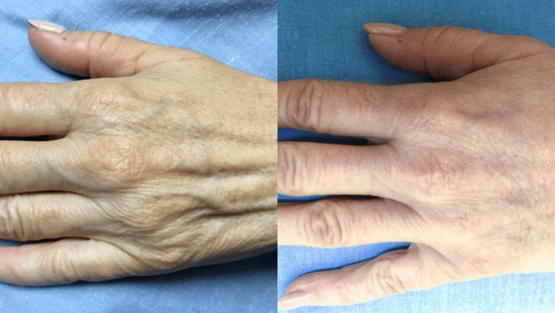 hand-rejuvenation-before-after