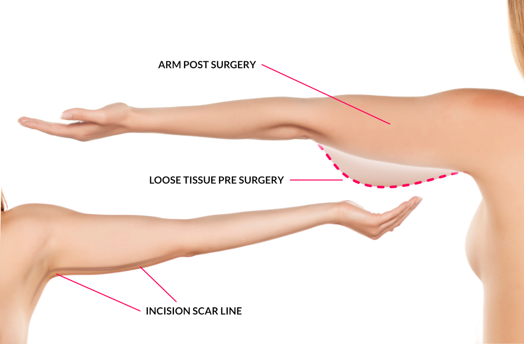 mrk-Arm